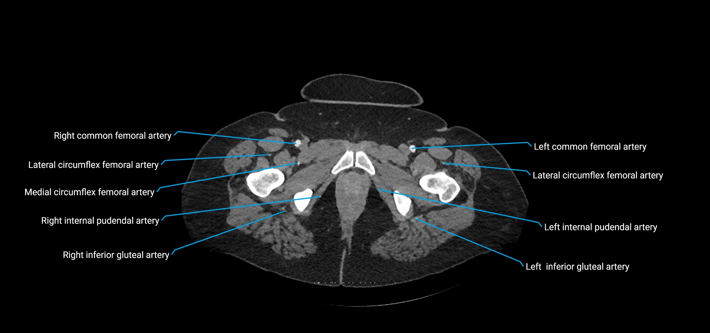 CTA abdomen axial cross sectional anatomy labelled image_269 (2).webp